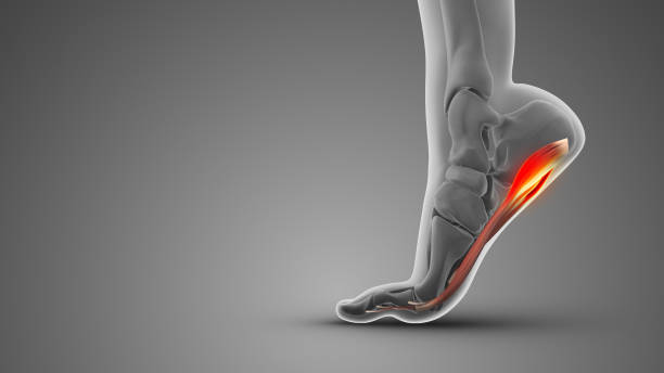 plantar fasciitis